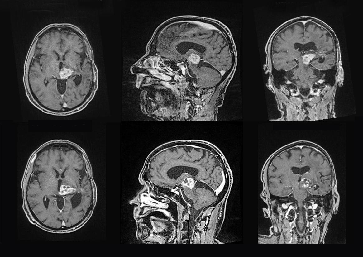 Focused Ultrasound MRI