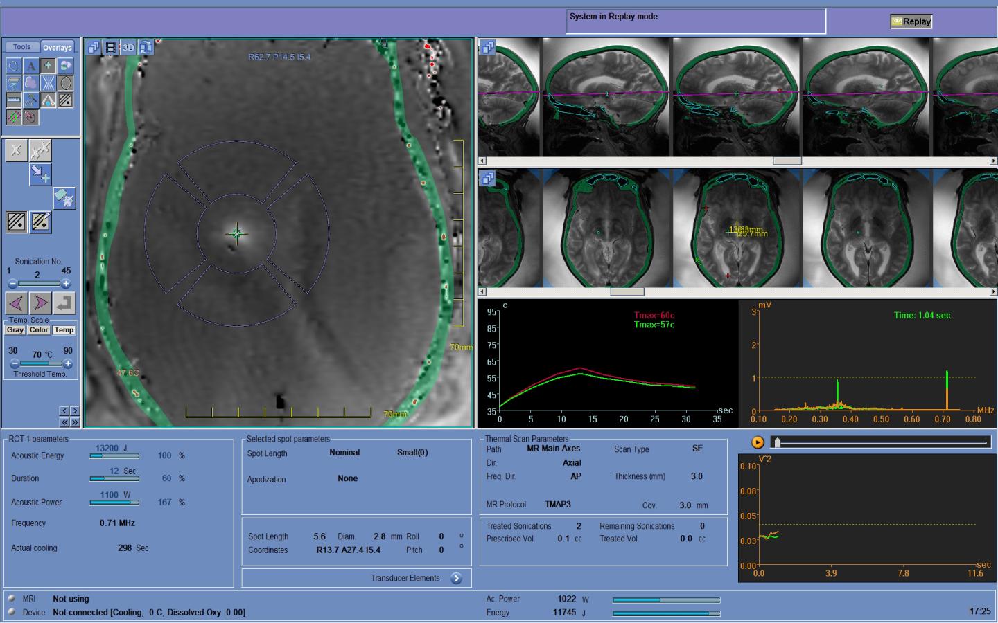 Focused Ultrasound treatment
