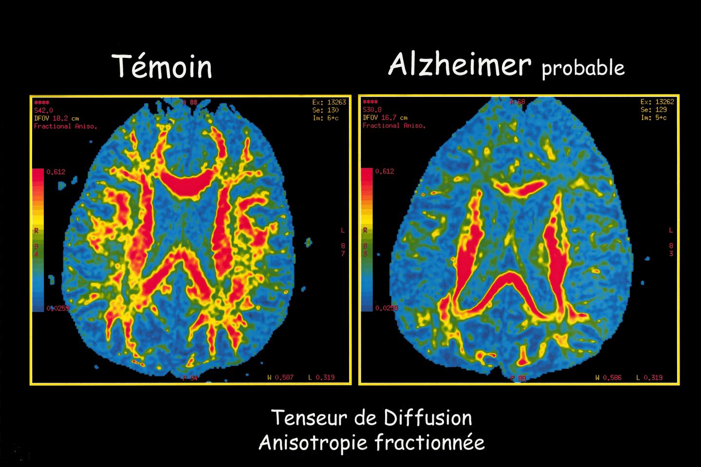 Alzheimer Disease, Mri