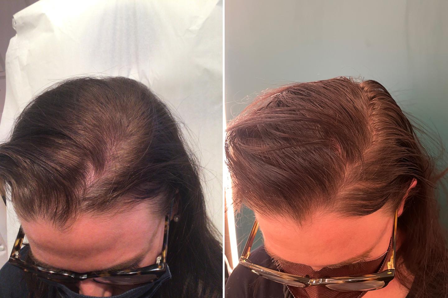 PRP treatments, before and after.