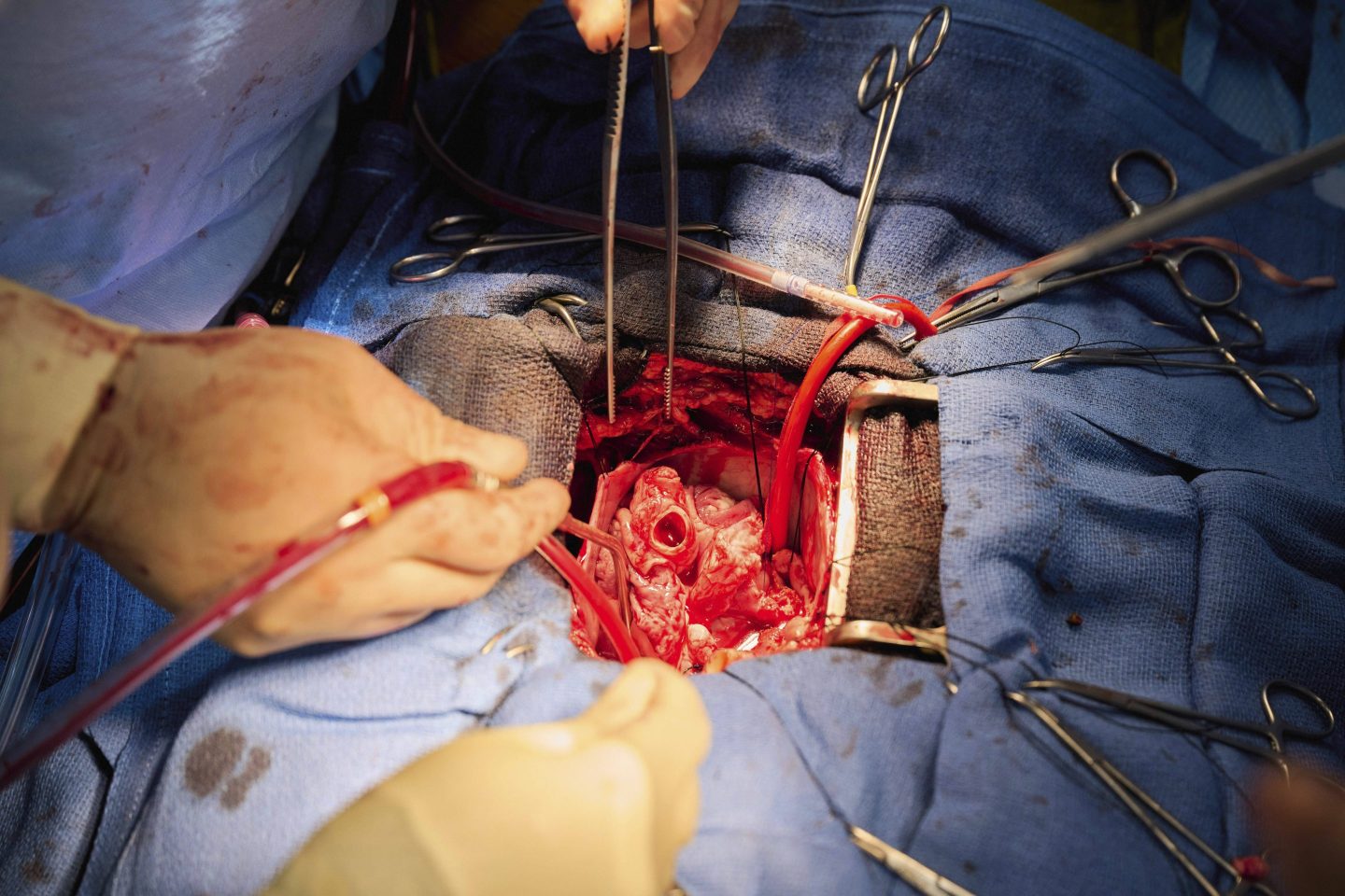 Pig-human heart transplants